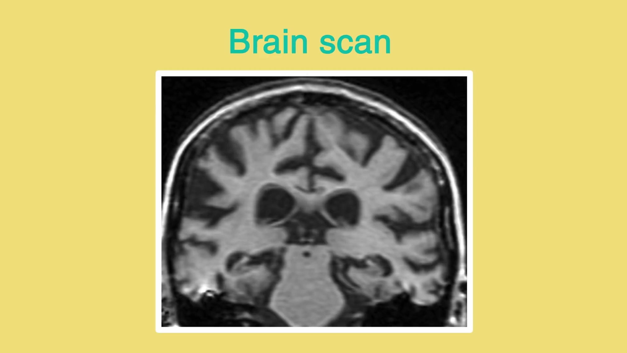 What is dementia - Alzheimers Society (3)